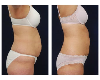 Liposuction 495485