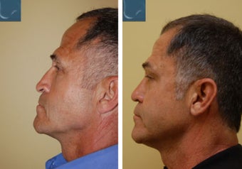 Revision Rhinoplasty before 346248