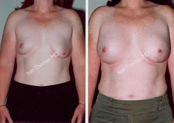 Breast Reconstruction before 243025