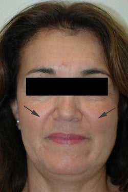 Restylane for laugh lines before 91298