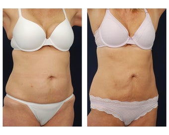 Liposuction after 495485