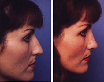 Rhinoplasty before 55726