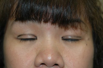 Asian eyelid surgery -- Double lid crease procedure 341490
