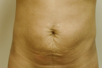 SmartLipo Abdomen before 141875