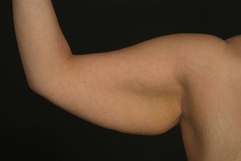 Arm Lift before 289481