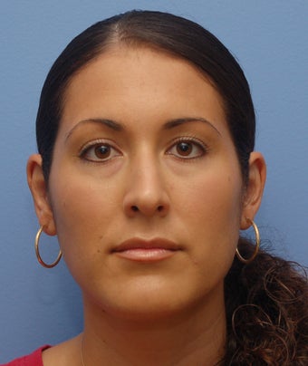 Otoplasty after 273231