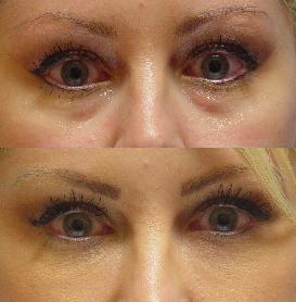 Juvederm injection in the tear troughs before 251714
