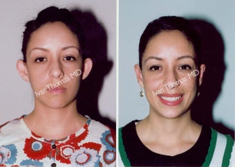 Ear Surgery - Otoplasty before 243391