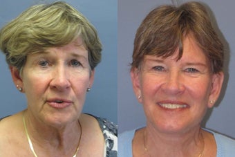 Lite lift, Neck Lift, Brow Lift before 523475