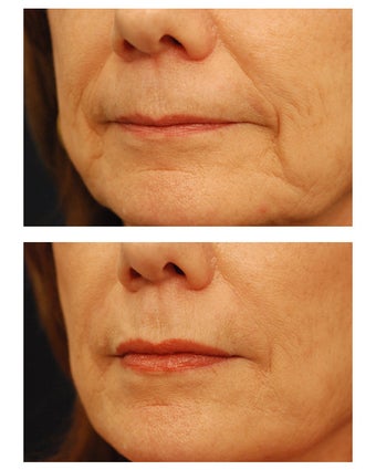 Restylane before 149904