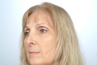 Revision Rhinoplasty 358580