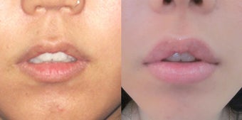 Non Surgical Lip Enhancement before 574817