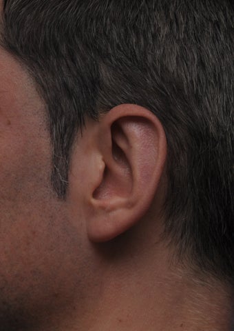 Otoplasty 361344