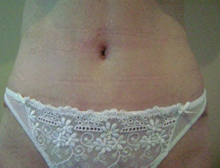 Tummy Tuck after 172689