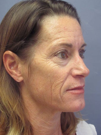 Obagi Blue Peel before 635061