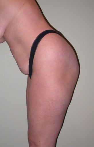 Breast lift, abdominoplasty, liposuction before 273345