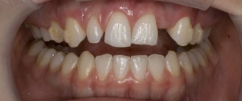 Porcelain Bridge and Veneers before 374741