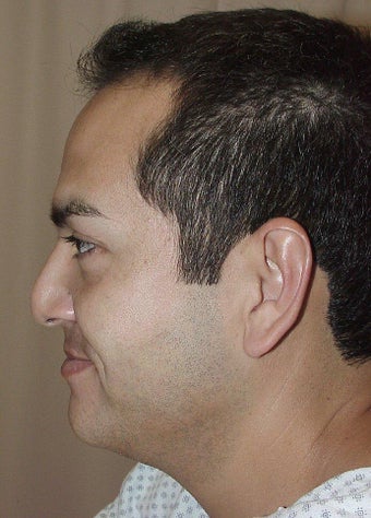 Revision Rhinoplasty before 299761