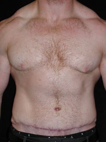 Male Tummy Tuck, Flank Liposuction, Male Breast Reduction after 550017