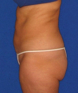 Liposuction, SmartLipo™ after 312311