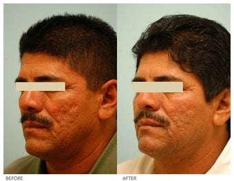 Acne Scarring Correction after 136799