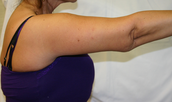 Brachioplasty (Arm lift) after 263698
