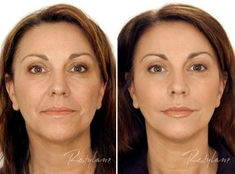 Restylane Full Face Treatment before 6276