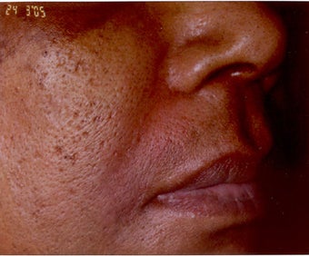 Restylane/Juvederm after 469313