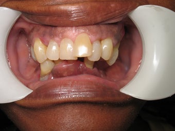 Smile makeover before 372806