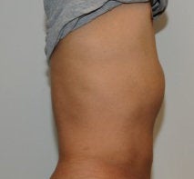 Smartlipo in Males after 123628