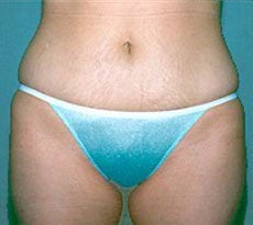 Smartlipo after 401651