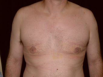 Gynecomastia Reduction Surgery after 233769