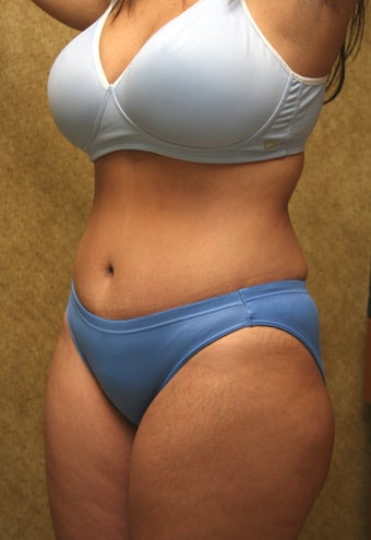 tummy tuck after 304681