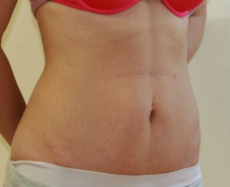 Mini-abdominoplasty 493679