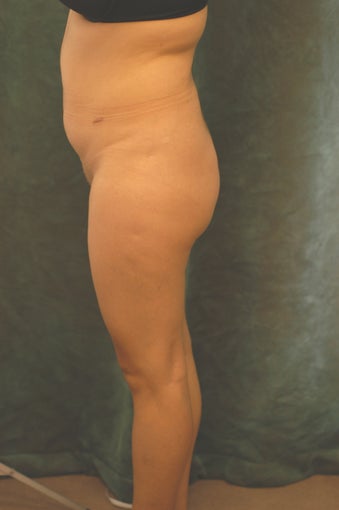 Women's Buttocks Augmentation before 518152