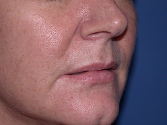 Before and After Lip Juvederm before 57749