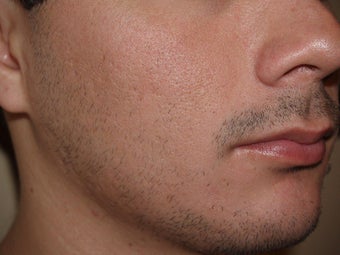 Facial Hair Transplant 321260