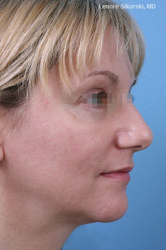Fractional CO2 Laser Resurfacing after 114176