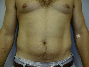 Male contouring liposuction before 590924