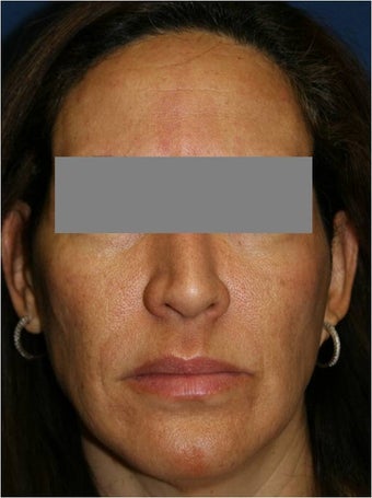 47 year old female treated for melasma, age spots, large pores and rough skin texture before 645449