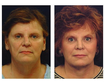 Neck Lift after 354243