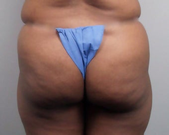 Butt Augmentation before 273288