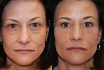 Non-surgical facial rejuvenation with Silikon-1000 and Botox. before 500581