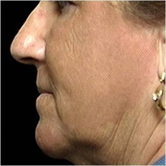 CO2 Laser Skin Resurfacing after 255555