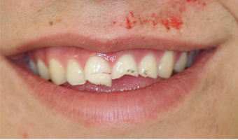 Veneers and crowns before 145694