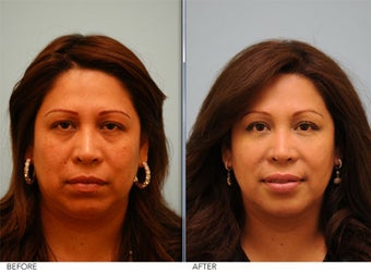 Restylane before 421898