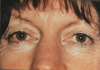 Fractional CO2 Resurfacing and upper bleph before 549802
