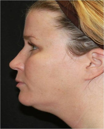 Ultherapy 445623