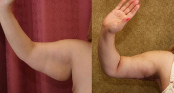 Brachioplasty or arm tuck in los angeles before 583686