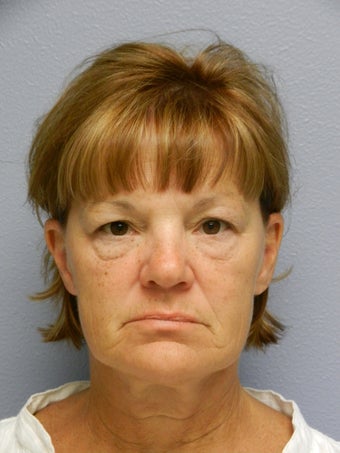 Lower Face with Neck Lift before 574623